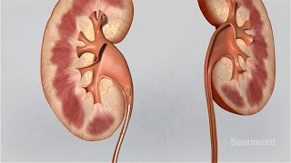 Kidney Stones Symptoms and Treatments [upl. by Alvera]