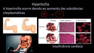 Patologia básica Adaptações celulares Hipertrofia hiperplasia metaplasia e atrofia [upl. by Llenaj]