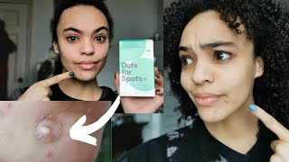 Dots For Spots Review  Do Spot Patches Really Work [upl. by Anerhs841]