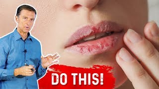 How To Fix Your Chapped Lips – DrBerg On Remedy For Chapped Lips [upl. by Kone]