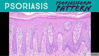 Psoriasis amp Psoriasiform Dermatitis Pattern  Inflammatory Dermpath Basics for Dermatology Pathology [upl. by Cho597]