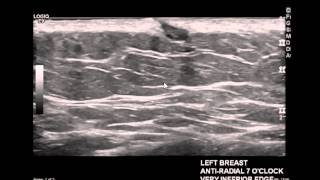 Digital Breast Tomosynthesis calcifications lymph nodes and stable masses [upl. by Igig206]