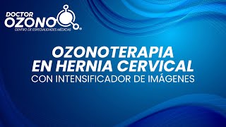 OZONOTERAPIA EN HERNIA CERVICAL CON INTENSIFICADOR DE IMAGENES  DOCTOR OZONO [upl. by Ainniz]