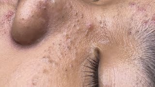 ACNE TREATMENT VU QUYNH MI  Blackheads Chin amp Nose Of Tweens 2024 FULL [upl. by Ikcim]