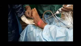 Ankle Arthroscopy Basics Portals Placement amp surgery for Ankle Impingement [upl. by Ellenehs]