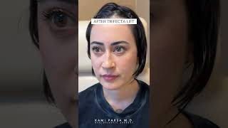 Eye Bags Goodbye Before and After Trifecta Lift with Dr Kami Parsa [upl. by Llehcam]