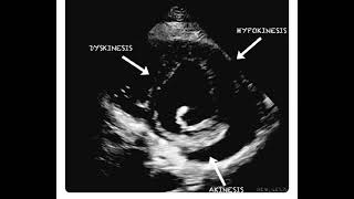 Hypokinesia Dyskinesia and Akinesia in a Single Echocardiography Frame [upl. by Adnuhsat217]