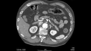 Aortic Dissection  QMH AED Ultrasound Casebook 201409 Video 7 [upl. by Enihsnus333]