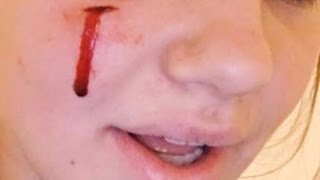 Sunny Obama Allegedly Bites 18YearOld Family Friend In The Face [upl. by Hnib349]