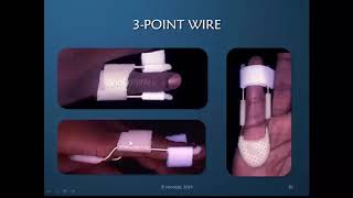 Obstinate PIP Joint Part 9 of 12 PIP Static ProgressiveDynamic Extension Orthoses Discussion [upl. by Cassey]