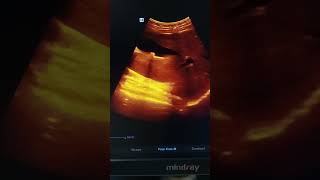 Cholelithiasis Ultrasound shorts videoshorts [upl. by Cruickshank]