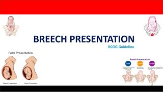 Management of Breech Presentation RCOG Guideline [upl. by Querida]