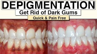 Black Gums How To Get Rid Of Them With Gum Depigmentation [upl. by Nacnud]