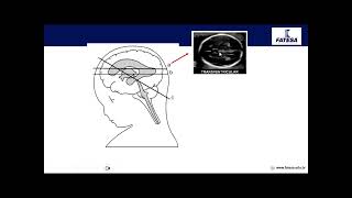 Aula Teórica Teus Ginecologia e Obstetrícia  Neurossonografia Fetal [upl. by Namara70]