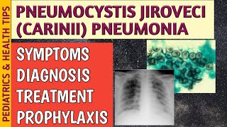 Pneumocystis Jiroveci Pneumonia P Carinii Symptoms Radiology Treatment amp Prophylaxis [upl. by Kasey]