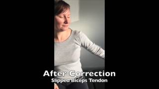 Slipped Biceps Tendon Correction [upl. by Forelli]