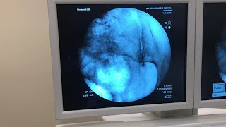 IntraArticular Injection of the Sacroiliac Joint Under Fluoroscopic Guidance [upl. by Naugal]