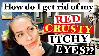 Blepharitis  2 Easy steps to banish red crusty itchy eyes  The Eye Surgeon [upl. by Franklyn]