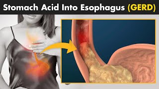 What Happens In Gastroesophageal reflux disease GERD  Symptoms Causes And Treatment [upl. by Nolram281]