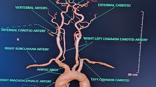 BRAIN AND NECK ANGIOGRAPHY On ct scanALL ABOUT ANGIOGRAPHYPART2CONCEPT ON ANGIOGRAPHY [upl. by Nossila]