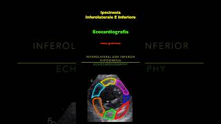 Ecocardiografia  Ipocinesia Inferolaterale E Inferiore [upl. by Nivrem]