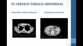 Enfoque de la adenopatias umh1931 [upl. by Prady]