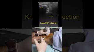 Knee PRP injection [upl. by Gem]