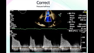 Mitral Stenosis Echocardiographic Assessment [upl. by Hsekar695]