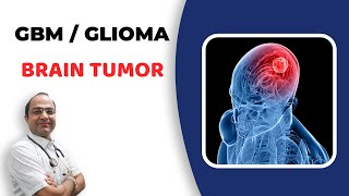 Glioma Brain Tumour Treatment  GlioblastomaGBM Cancer  दिमाग का कैंसर  Best Homeopathic Doctor [upl. by Yeltrab]