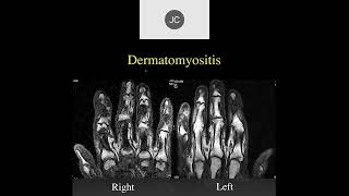 MRI of the Wrist Part 15  Wrist Inflammation [upl. by Temp]