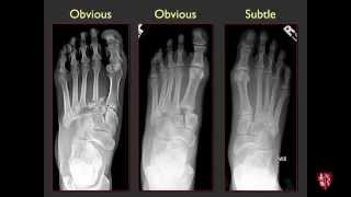 Tarsometatarsal Joints and Midfoot Lisfranc Sprains [upl. by Wahkuna]