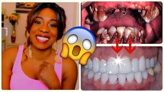 Astuce INCROYABLE DENTS POURRIES À DES DENTS BLANCHES DE STAR [upl. by Nyladnarb]