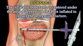 Tibial Plateau Fracture Balloon Osteoplasty  Everything You Need To Know  Dr Nabil Ebraheim [upl. by Hyozo]