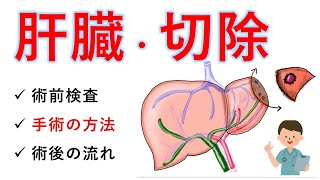 大腸癌・肝転移の手術の実際の流れを解説します。【医師解説】2022年 [upl. by Refinej606]