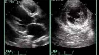 AC ANTEROSEPTAL MYOCARDIAL INFARCTION [upl. by Fisoi]