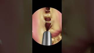 ASMR Nose Treatment Part 2  3D Animation Surgery asmr 3danimation shorts surgery treatment [upl. by Dupuy]