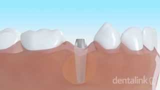 IMPLANTE DENTAL óseo integrado  Video 3D paso a paso [upl. by Levona]