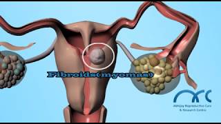 Hysterosalpingogram Procedure  Hysterosalpingogram Video  ARC Chennai [upl. by Rosenfeld342]