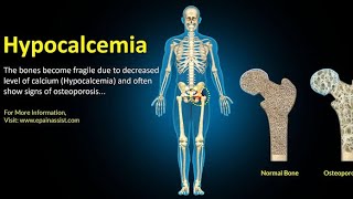 Treatment of hypocalcemia AACCM [upl. by Gombosi]