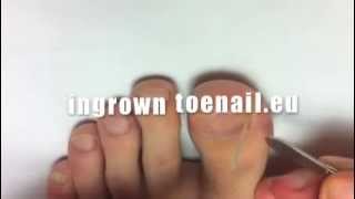 How to apply ingrown toenail treatment brace AT HOME [upl. by Anih]