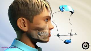 Palatal Expander with Reverse Pull Headgear  Dental Braces  Temecula Valley CA [upl. by Adnuhser]