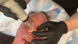 Treating Rhinophyma nose with CO2 Laser  Facial RejuvenationResurfacing Part 3  Dr Jason Emer [upl. by Feledy]