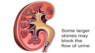 How Kidney Stones Are Formed Animation  Renal Calculi Causes amp Symptoms Video  Blocked Urine Flow [upl. by Ydnys601]