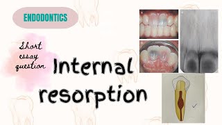 Internal resorptionEndodonticsshort essaywith easy notesimportantquestions easy dentalstudies [upl. by Eanehs]