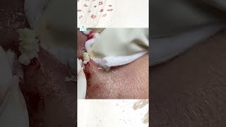 Big Cystic Acne Blackheads Extraction Blackheads amp Milia Whiteheads Removal Pimple Popping shorts [upl. by Hilton]