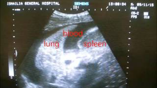 A quick diagnosis of hemothorax by ultrasound [upl. by Alleber]