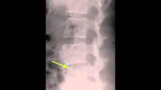 Burst Fracture L4 on X ray and CT [upl. by Halak]