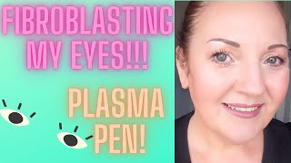 FIBROBLASTING MY EYES PLASMA PEN [upl. by Mcleod]