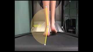 Over Pronation and how this is measured in walking [upl. by Bunce]