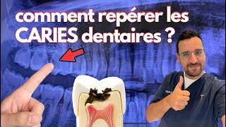 Apprendre à REPÉRER une CARIE DENTAIRE  Comprendre ensemble en 2min [upl. by Destinee730]